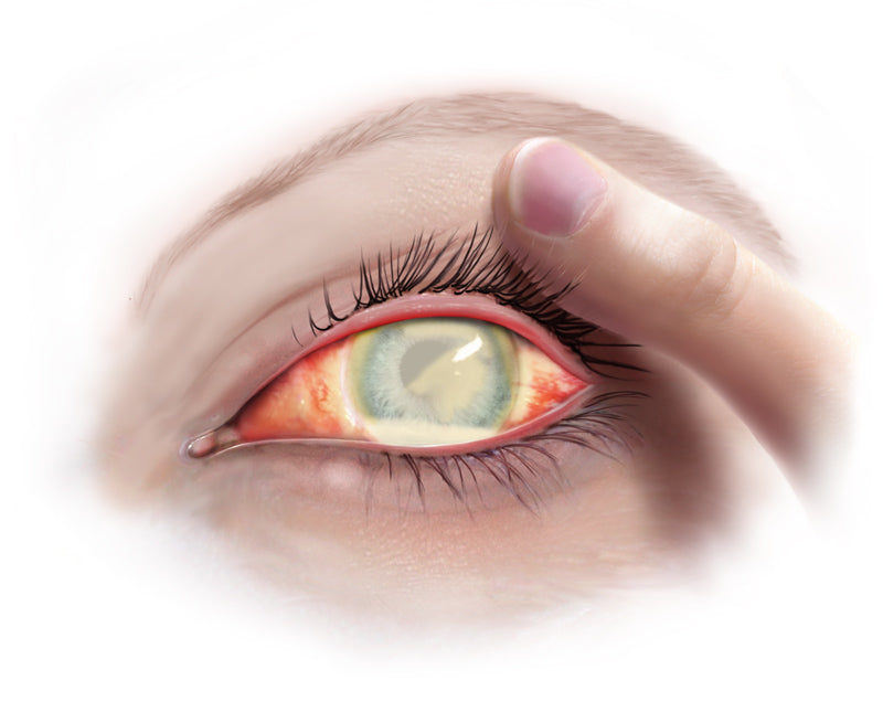 Eye disease  -  Endoftamit