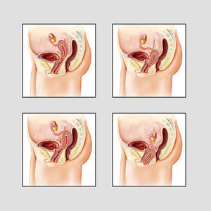 Genital descensus illustration